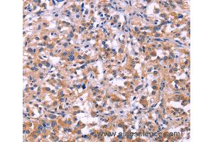 Immunohistochemistry of Human thyroid cancer using MMP14 Polyclonal Antibody at dilution of 1:40 (MMP14 Antikörper)