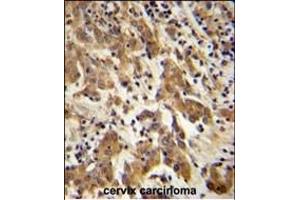GK Antibody (C-term) (ABIN651665 and ABIN2840349) immunohistochemistry analysis in formalin fixed and paraffin embedded human cervix carcinoma followed by peroxidase conjugation of the secondary antibody and DAB staining. (GKAP1 Antikörper  (C-Term))