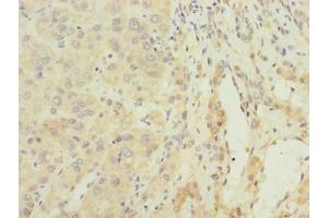 Immunohistochemistry of paraffin-embedded human liver cancer using ABIN7144623 at dilution of 1:100 (ARMCX2 Antikörper  (AA 161-460))
