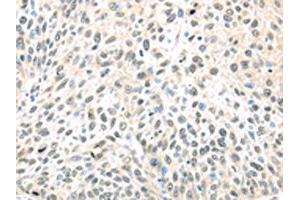 The image on the left is immunohistochemistry of paraffin-embedded Human lung cancer tissue using ABIN7128027(TCEB1 Antibody) at dilution 1/40, on the right is treated with fusion protein. (TCEB1 Antikörper)