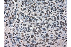 Immunohistochemical staining of paraffin-embedded Adenocarcinoma of breast tissue using antiHSPA9 mouse monoclonal antibody. (HSPA9 Antikörper)