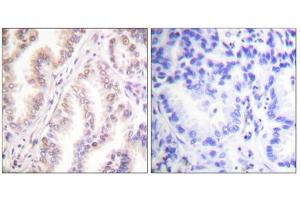 Immunohistochemistry analysis of paraffin-embedded human lung carcinoma tissue using PIAS1 antibody. (PIAS1 Antikörper  (N-Term))