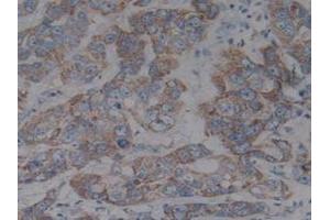 Detection of IkBb in Human Liver Tissue using Polyclonal Antibody to Inhibitory Subunit Of NF Kappa B Beta (IkBb) (Inhibitory Subunit of NF kappa B beta (AA 85-332) Antikörper)