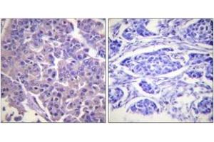 Immunohistochemistry analysis of paraffin-embedded human breast carcinoma tissue, using Caldesmon (Ab-789) Antibody. (Caldesmon Antikörper  (AA 744-793))