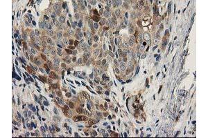 Immunohistochemical staining of paraffin-embedded Adenocarcinoma of Human breast tissue using anti-MAPRE2 mouse monoclonal antibody.