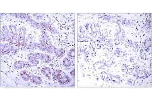 Immunohistochemistry analysis of paraffin-embedded human breast carcinoma tissue, using STAT4 (Ab-693) Antibody. (STAT4 Antikörper  (AA 660-709))