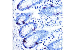 Immunohistochemistry of paraffin-embedded human colon carcinoma using Zinc-α2-glycoprotein (ZAG/) Rabbit mAb (ABIN7265556) at dilution of 1:100 (40x lens). (AZGP1 Antikörper)