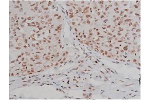 Immunohistochemistry (IHC) image for anti-Insulin-Like Growth Factor 1 Receptor (IGF1R) (pTyr1346) antibody (ABIN6256637)