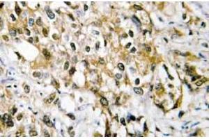 Immunohistochemistry (IHC) analyzes of c-Myc antibody in paraffin-embedded human liver carcinoma tissue. (c-MYC Antikörper)