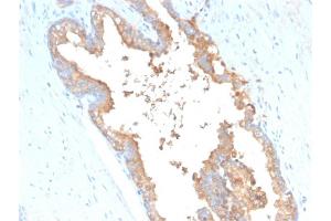 Formalin-fixed, paraffin-embedded human Prostate Carcinoma stained with Transferrin Mouse Monoclonal Antibody (TF/3001). (Transferrin Antikörper  (AA 311-445))