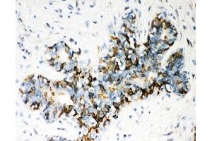 IHC-P: ABCB4 antibody testing of human breast cancer tissue
