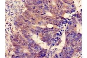 Immunohistochemistry of paraffin-embedded human colon cancer using ABIN7159726 at dilution of 1:100 (MGST2 Antikörper  (AA 27-57))