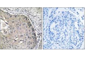 Immunohistochemistry analysis of paraffin-embedded human lung carcinoma tissue, using AOX1 Antibody. (AOX1 Antikörper  (AA 521-570))