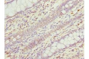 Immunohistochemistry of paraffin-embedded human colon cancer using ABIN7167615 at dilution of 1:100 (RGS5 Antikörper  (AA 1-181))