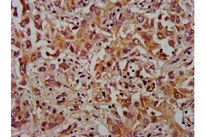 IHC image of ABIN7175929 diluted at 1:1000 and staining in paraffin-embedded human liver cancer performed on a Leica BondTM system. (XKR8 Antikörper  (AA 69-158))