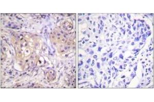 Immunohistochemistry analysis of paraffin-embedded human breast carcinoma, using PKC-pan (Phospho-Thr497) Antibody. (PKC Antikörper  (pThr497))