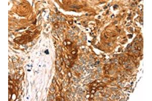 The image on the left is immunohistochemistry of paraffin-embedded Human esophagus cancer tissue using ABIN7192788(THAP9 Antibody) at dilution 1/20, on the right is treated with synthetic peptide. (THAP9 Antikörper)