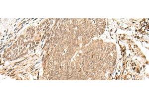 Immunohistochemistry of paraffin-embedded Human esophagus cancer tissue using VPS50 Polyclonal Antibody at dilution of 1:45(x200) (Syndetin/VPS50 Antikörper)