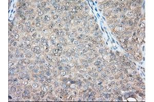 Immunohistochemical staining of paraffin-embedded Adenocarcinoma of Human colon tissue using anti-BSG mouse monoclonal antibody. (CD147 Antikörper)