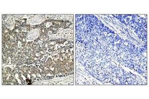 Immunohistochemical analysis of paraffin-embedded human breast carcinoma tissue using p56Dok-2(Phospho-Tyr299) Antibody(left) or the same antibody preincubated with blocking peptide(right). (DOK2 Antikörper  (pTyr299))