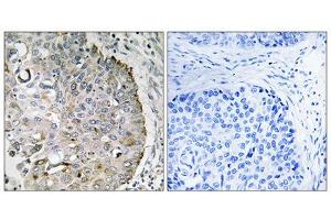 Immunohistochemistry analysis of paraffin-embedded human lung carcinoma tissue, using MRRF antibody. (MRRF Antikörper  (C-Term))