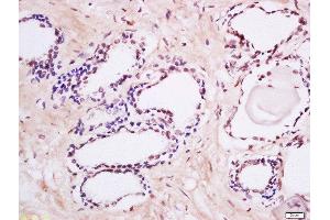 Formalin-fixed and paraffin embedded human prostate labeled with Anti-MAK (Tyr159) Polyclonal Antibody, Unconjugated  at 1:200 followed by conjugation to the secondary antibody and DAB staining. (MAK Antikörper  (pTyr159))