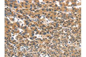 The image on the left is immunohistochemistry of paraffin-embedded Human liver cancer tissue using ABIN7192978(UBTD2 Antibody) at dilution 1/35, on the right is treated with synthetic peptide.