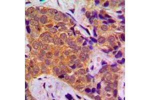 Immunohistochemical analysis of FOXO1 staining in human breast cancer formalin fixed paraffin embedded tissue section. (FOXO1 Antikörper  (Center))
