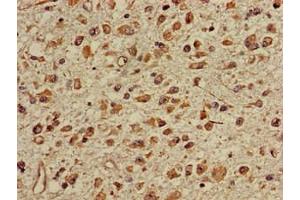 Immunohistochemistry of paraffin-embedded human glioma using ABIN7150673 at dilution of 1:100 (TGDS Antikörper  (AA 143-305))