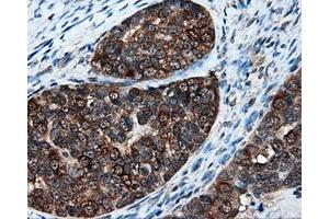 Immunohistochemical staining of paraffin-embedded Adenocarcinoma of breast tissue using anti-XRCC1 mouse monoclonal antibody.