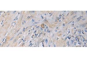 Immunohistochemistry of paraffin-embedded Human gastric cancer tissue using HSDL2 Polyclonal Antibody at dilution of 1:55(x200) (HSDL2 Antikörper)