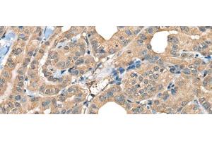 Immunohistochemistry of paraffin-embedded Human thyroid cancer tissue using CABP5 Polyclonal Antibody at dilution of 1:65(x200) (CABP5 Antikörper)