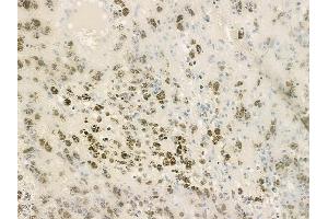 ABIN6259215 and ABIN6275631 at 1/100 staining human melanoma by IHC-P.