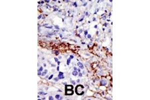 Formalin-fixed and paraffin-embedded human cancer tissue reacted with the primary antibody, which was peroxidase-conjugated to the secondary antibody, followed by DAB staining. (USP21 Antikörper  (C-Term))