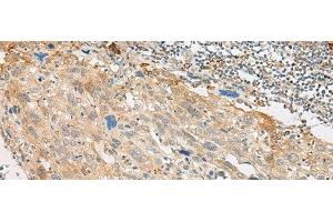 Immunohistochemistry of paraffin-embedded Human cervical cancer tissue using GPR151 Polyclonal Antibody at dilution of 1:45(x200) (GPR151 Antikörper)
