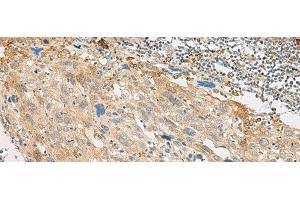 Immunohistochemistry of paraffin-embedded Human cervical cancer tissue using GPR151 Polyclonal Antibody at dilution of 1:45(x200) (GPR151 Antikörper)