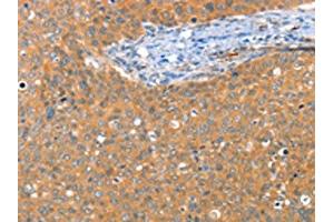The image on the left is immunohistochemistry of paraffin-embedded Human cervical cancer tissue using ABIN7128218(ACY3 Antibody) at dilution 1/25, on the right is treated with fusion protein. (Aminoacylase 3 Antikörper)