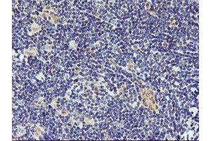 Immunohistochemical staining of paraffin-embedded Human lymphoma tissue using anti-DPP9 mouse monoclonal antibody. (DPP9 Antikörper)