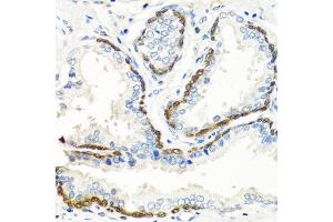 Immunohistochemistry of paraffin-embedded human prostate using BMP5 antibody. (BMP5 Antikörper)