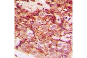 Immunohistochemical analysis of CLIP3 staining in human breast cancer formalin fixed paraffin embedded tissue section. (CLIP3 Antikörper)