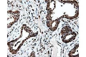 Immunohistochemical staining of paraffin-embedded Adenocarcinoma of ovary tissue using anti-PSMC3 mouse monoclonal antibody. (PSMC3 Antikörper)
