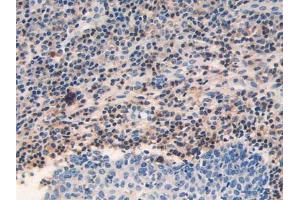 IHC-P analysis of Human Skin Cancer Tissue, with DAB staining. (GRK2 Antikörper  (AA 398-640))