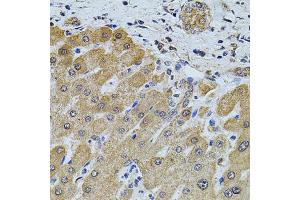 Immunohistochemistry of paraffin-embedded human liver injury using FOXO3 antibody (ABIN2736768) at dilution of 1:100 (40x lens). (FOXO3 Antikörper)