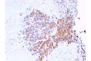 Formalin-fixed, paraffin-embedded human Melanoma stained with Topo I, MT Mouse Monoclonal Antibody (TOP1MT/568) (TOP1MT Antikörper)