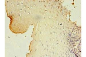 Immunohistochemistry of paraffin-embedded human cervical cancer using ABIN7153277 at dilution of 1:100 (GKAP1 Antikörper  (AA 21-366))