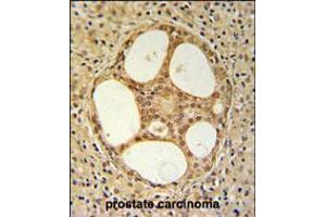 PRUNE Antibody IHC analysis in formalin fixed and paraffin embedded prostate carcinoma followed by peroxidase conjugation of the secondary antibody and DAB staining.