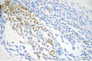Immunohistochemistry was performed on paraffin-embedded human sigmoid colon carcinoma using DUT antibody (ABIN7798312), 1:200). (Rekombinanter Deoxyuridine Triphosphatase (DUT) Antikörper)
