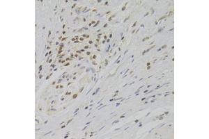 Immunohistochemistry of paraffin-embedded human gastric cancer using TAF1C Antibody (ABIN2560282) at dilution of 1:100 (40x lens).