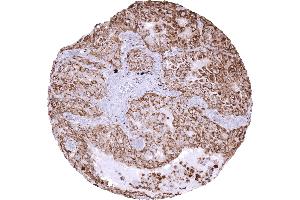 Adenocarcinoma of the lung with strong expression of Napsin A (Rekombinanter NAPSA Antikörper  (AA 189-299))