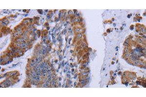Immunohistochemistry of paraffin-embedded Human esophagus cancer tissue using MT3 Polyclonal Antibody at dilution 1:50 (MT3 Antikörper)
